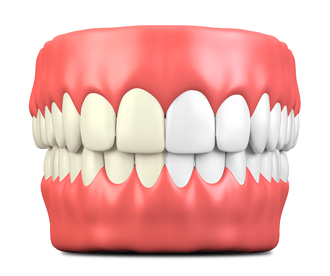 Dental model showing teeth alignment with gum tissue