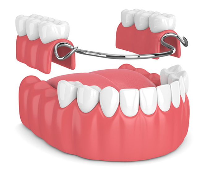 Illustration of dental partial denture set with pink gums and metal framework.