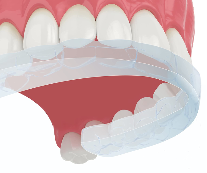 Illustration showing a dental clear aligner being fitted over teeth.