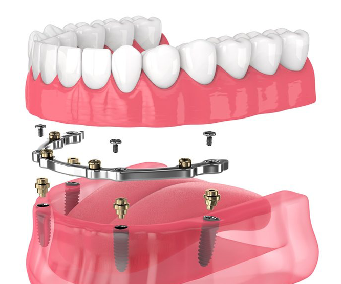 Illustration of dental implant system with artificial teeth and metal framework