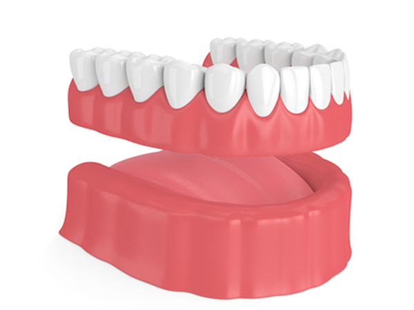 3D rendering of dental veneers on gums in open mouth model