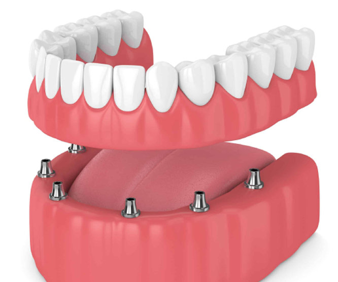 Dental implant with dentures illustration showing upper and lower sets of artificial teeth, pink gum base, and metal implant posts.