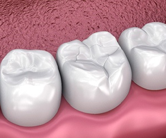 3D rendering of dental fillings on molar teeth in gums