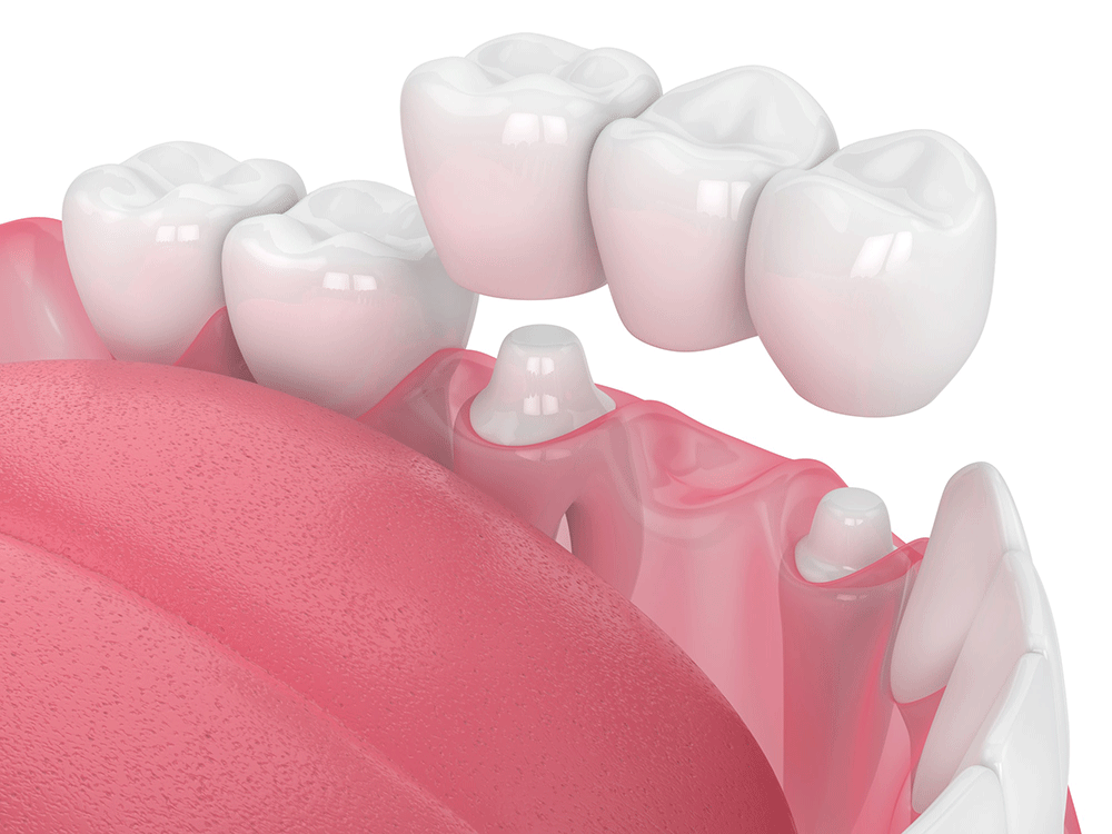 3D rendering of dental bridge placement with artificial teeth between crowns on implants, showing gums and surrounding teeth.