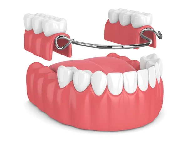 3D model of dental partial dentures with metal clasps