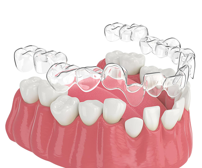 Illustration of a dental clear aligner above a set of teeth on an upper gum model.