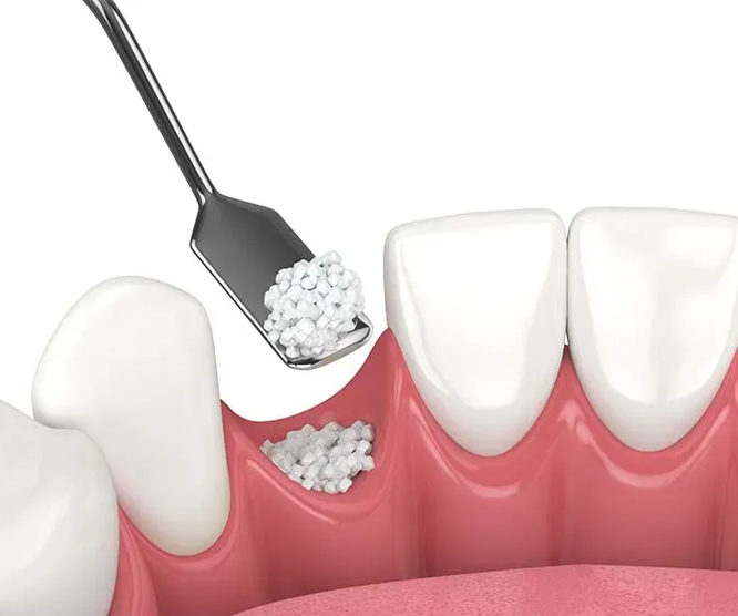 Illustration of dental bone grafting procedure with graft material being placed in the gum.
