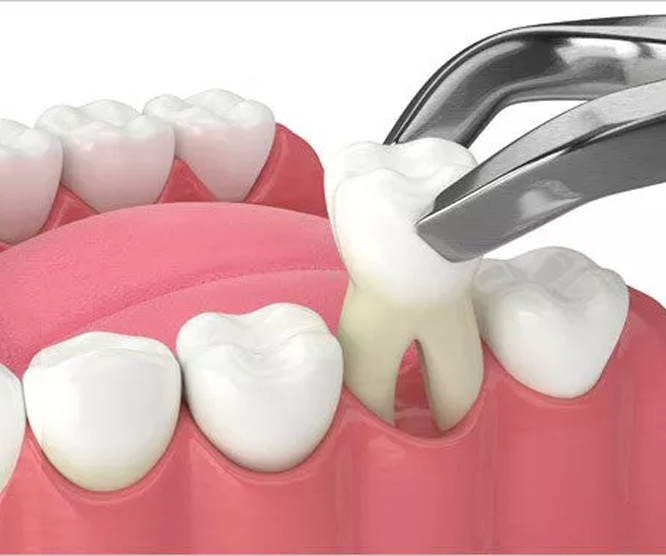 Illustration of tooth extraction with forceps