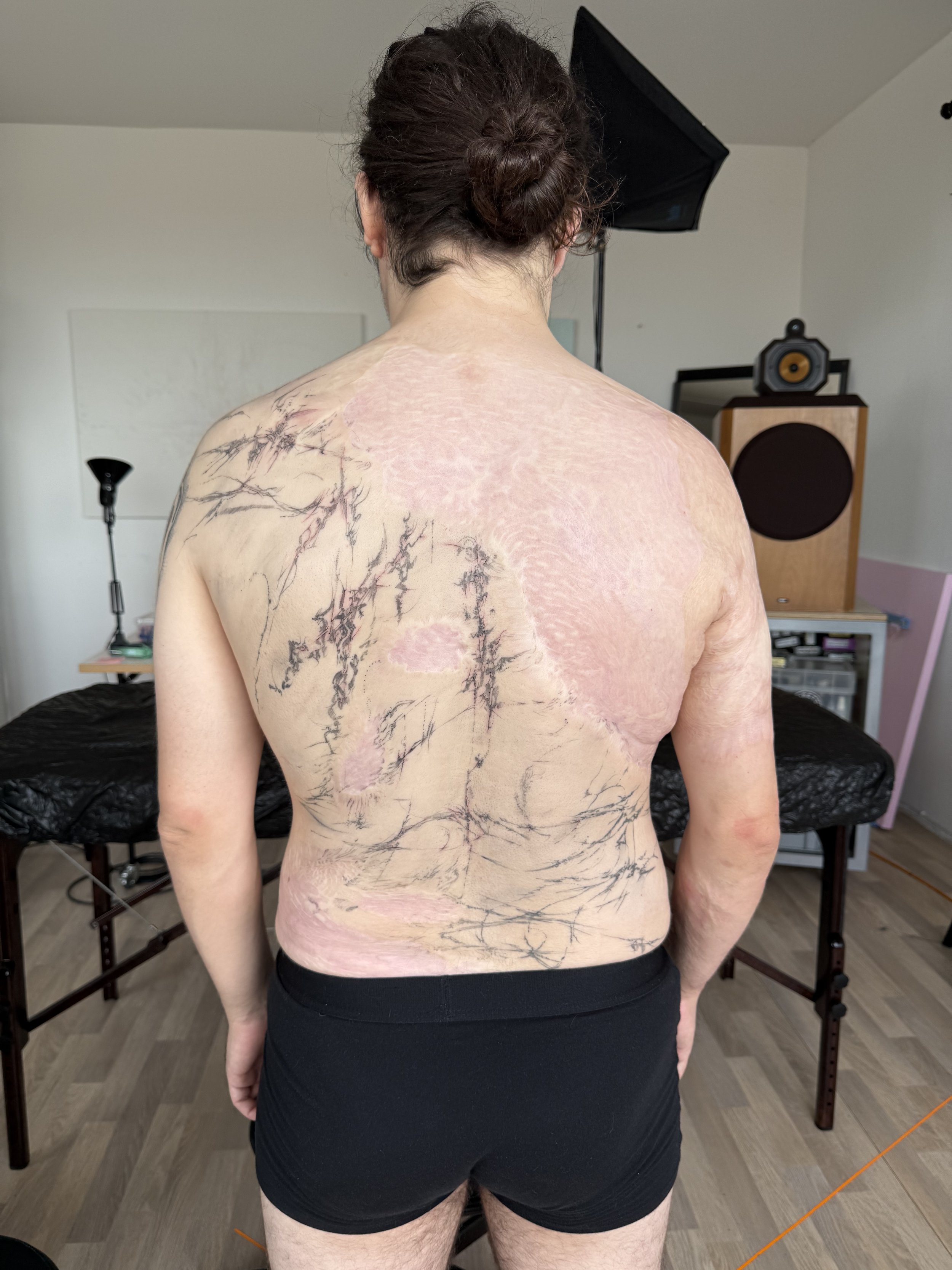 Back of a person with extensive scarring and skin grafts on the upper back and shoulders, standing in a room with medical and recording equipment.