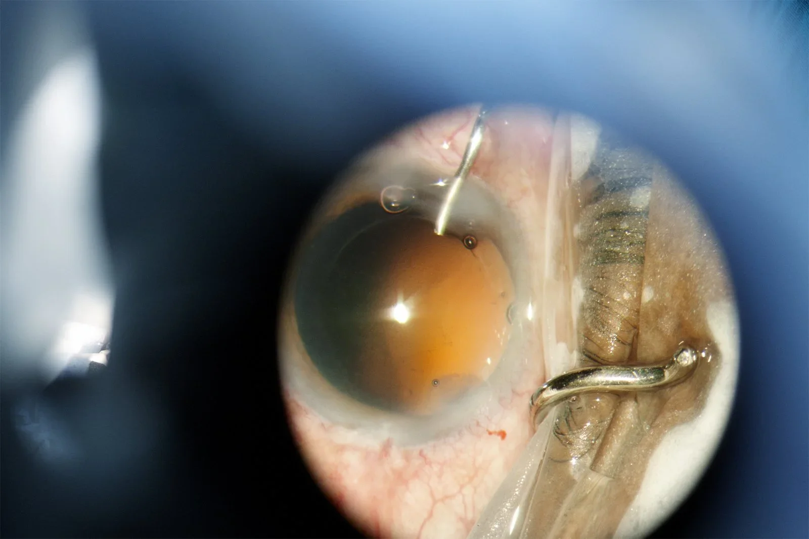 Close-up of an eye during a surgical procedure, with medical instruments and a bright light reflecting on the eye.