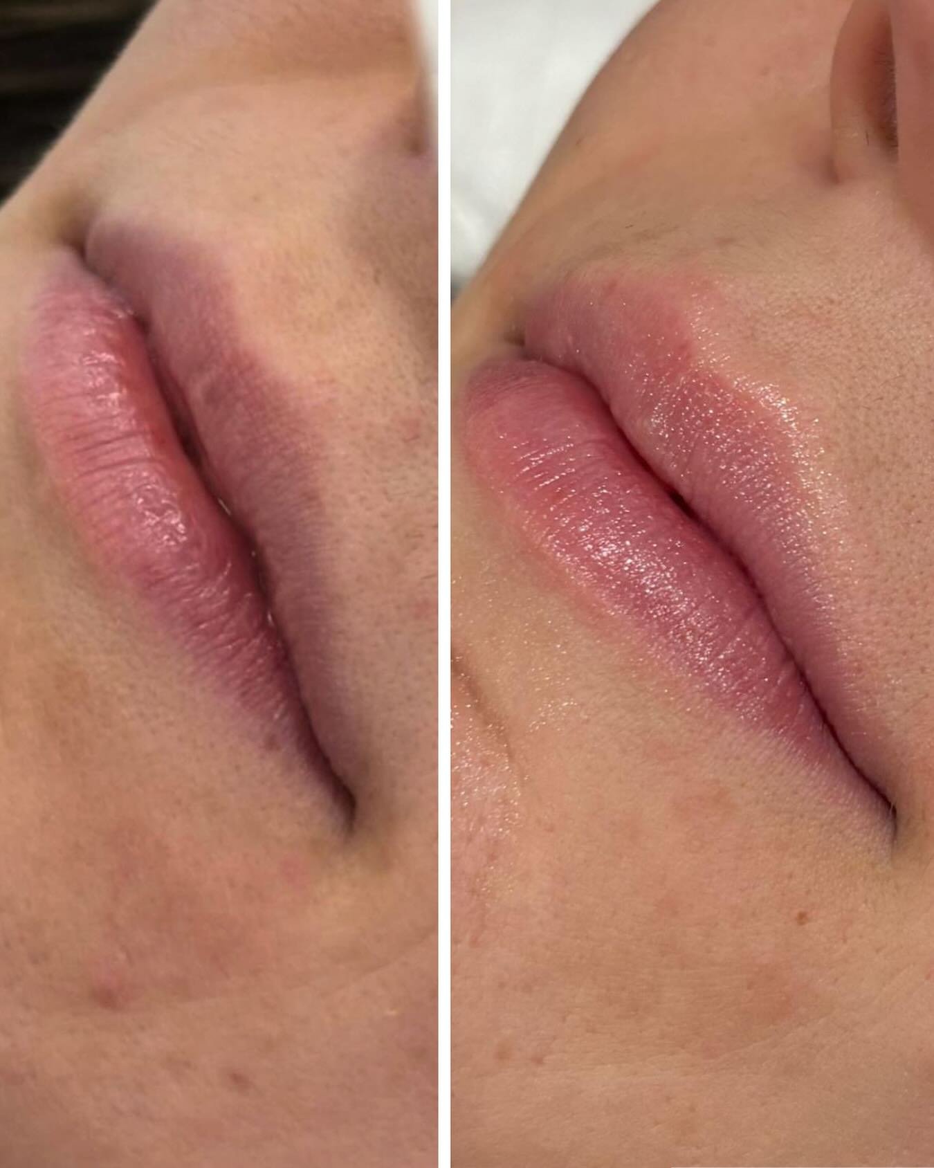 Resultats naturals amb Hydralips.
Una hidrataci&oacute; labial millora la textura, la lluminositat i el contorn sense modificar la teva expressi&oacute;.

Vine a fer-te valoraci&oacute; amb el nostre equip m&egrave;dic✨

📲 669 554 016