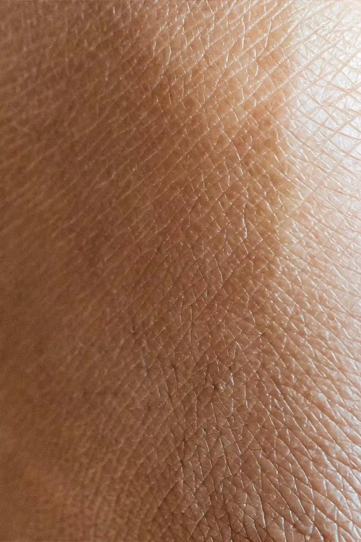 Láser en clínica de medicina estética en Badalona