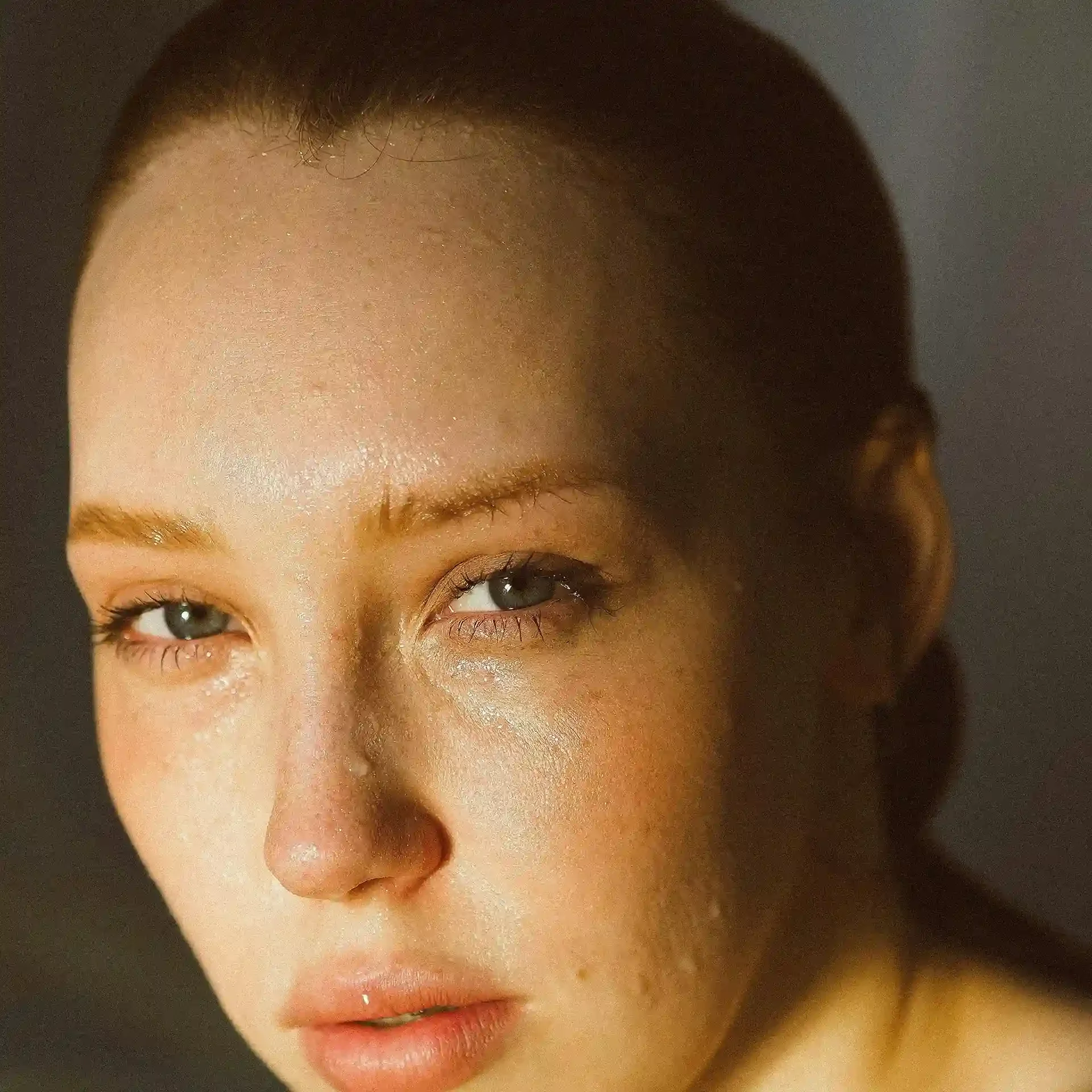 Tratamiento de bótox en tercio superior para arrugas de expresión en Badalona Barcelona