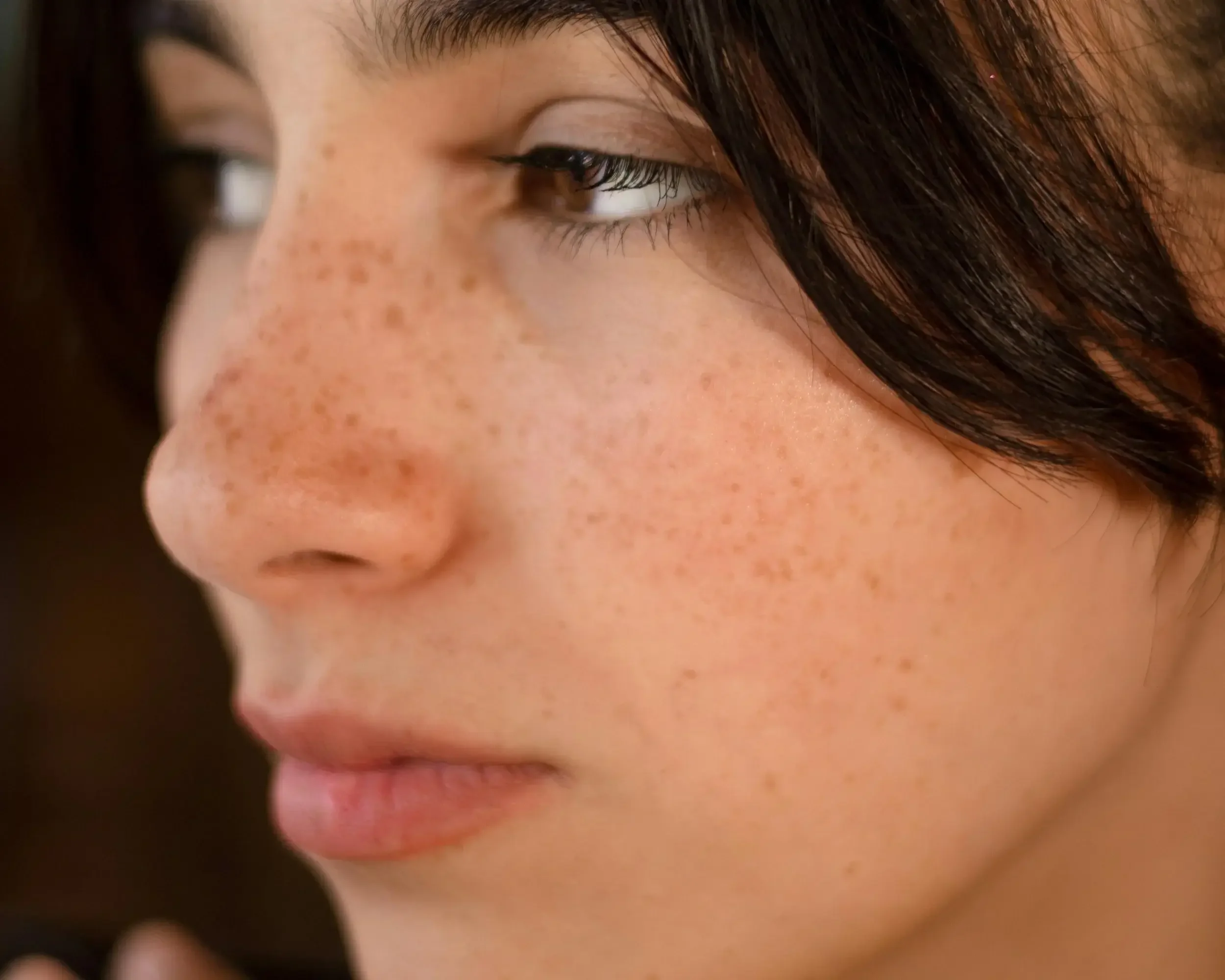 Relleno de surcos nasogenianos con ácido hialurónico en Badalona Barcelona