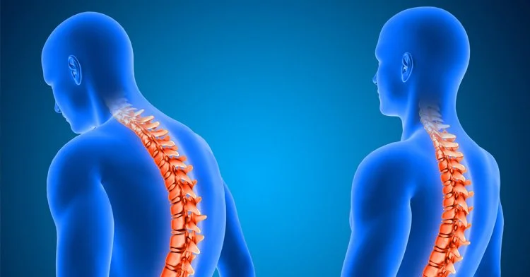 Poor Posture