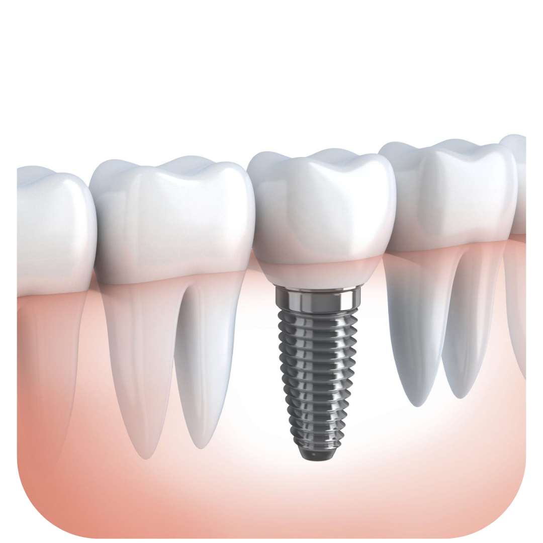 Implante Dentário