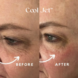 Cold Plasma Facials: The Gentle Powerhouse Treatment You Haven’t Tried Yet