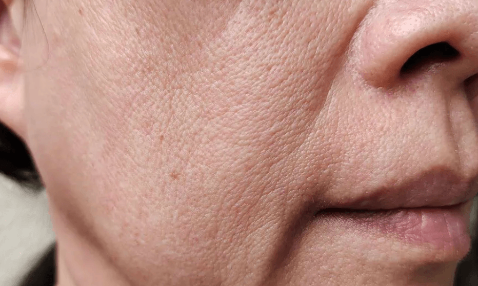 Why Your Skin Looks Different When You're Losing Weight (And What to Do About It)