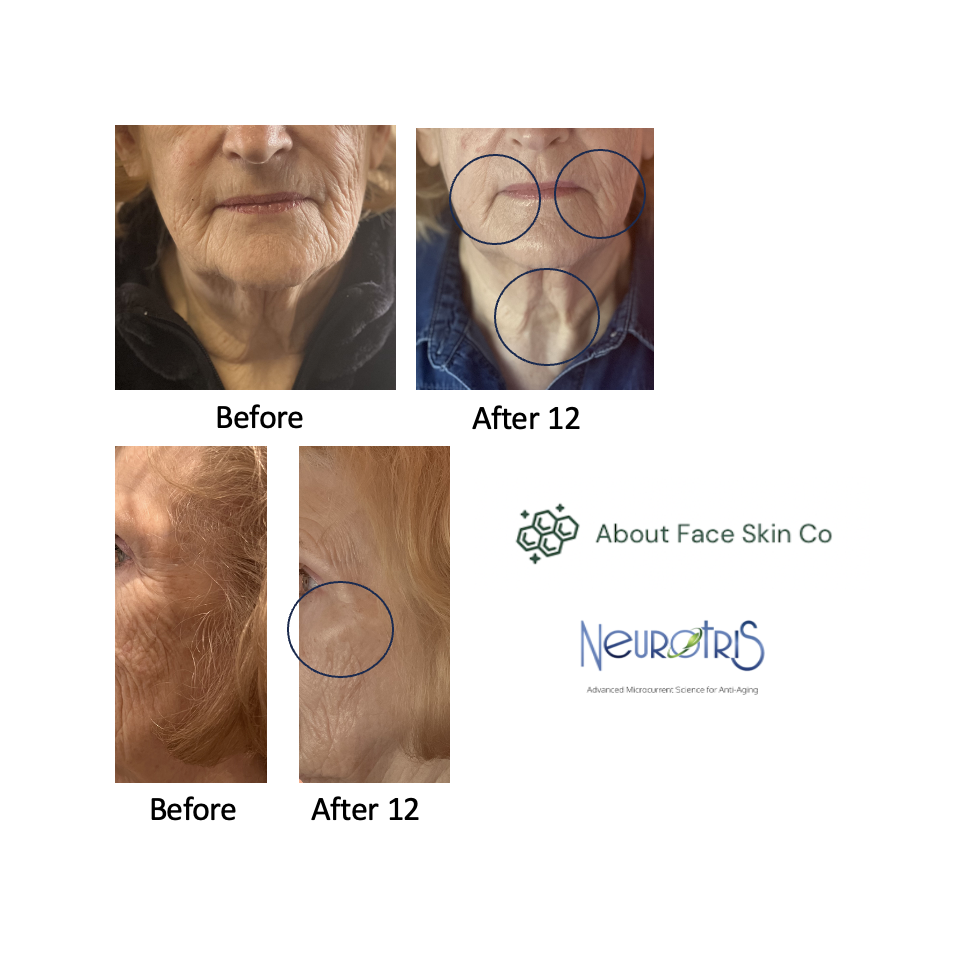 Before and after images of mature women showing skin tightening improvements before and after Neurotris collagen lift facial treatment at About Face Skin Co.