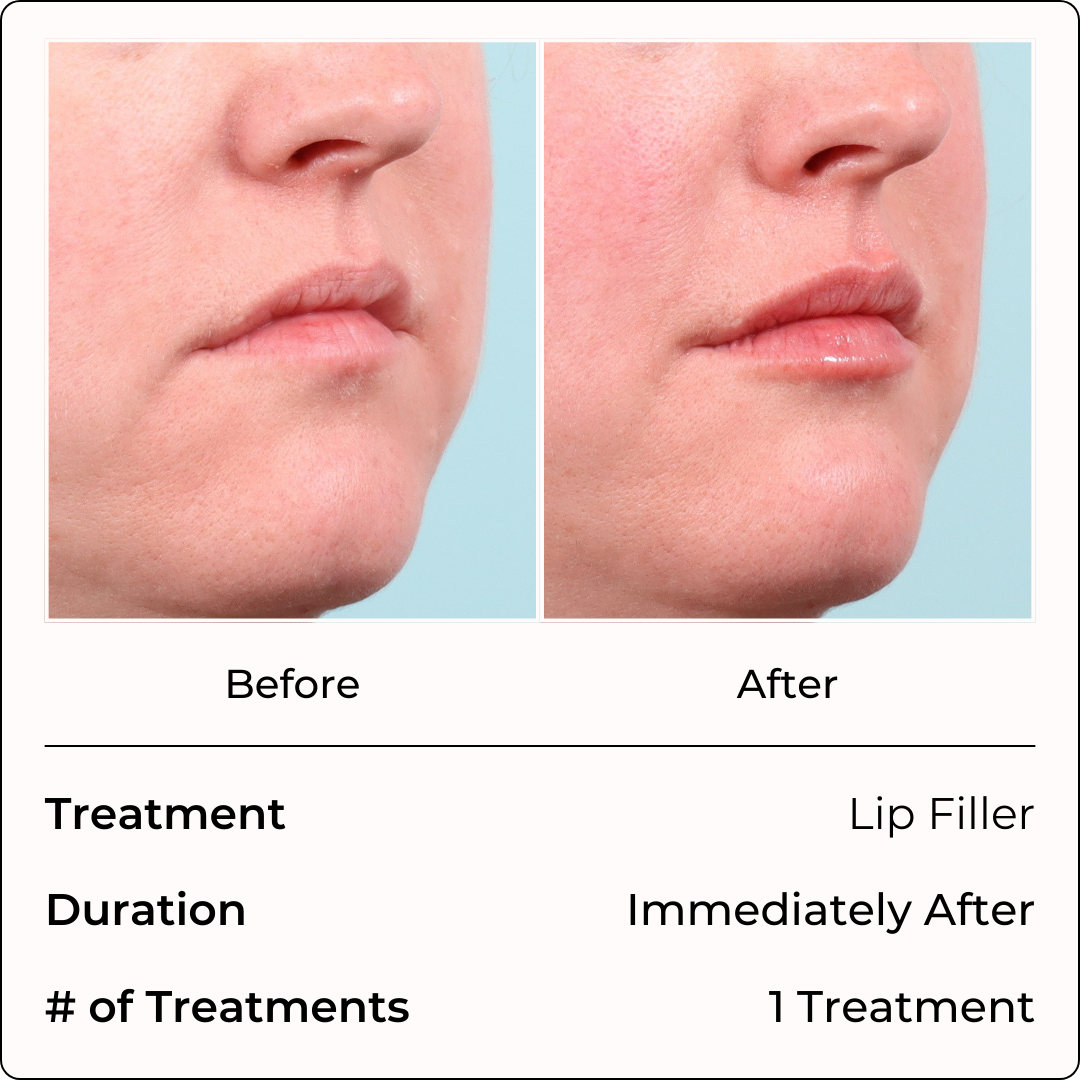 Filler Injections