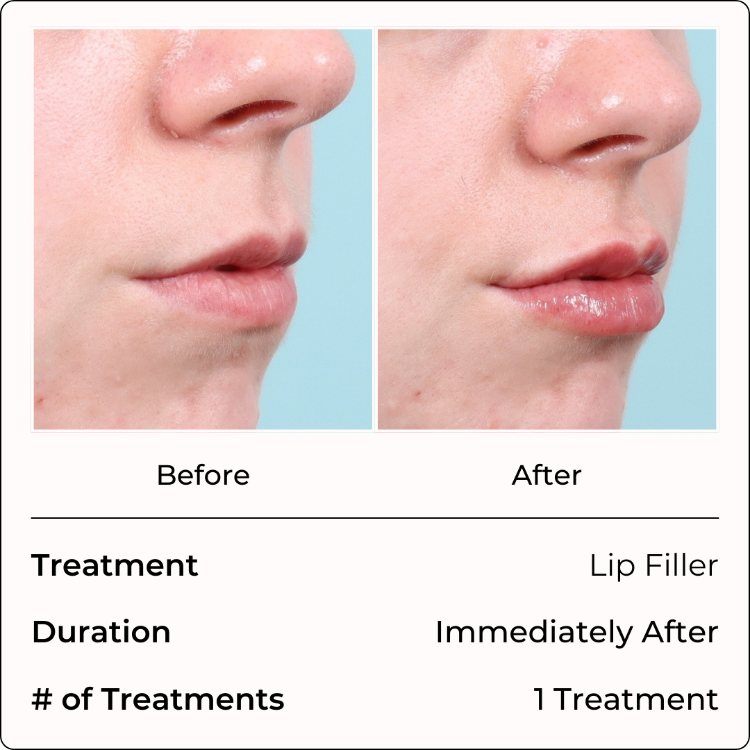 Filler Injections