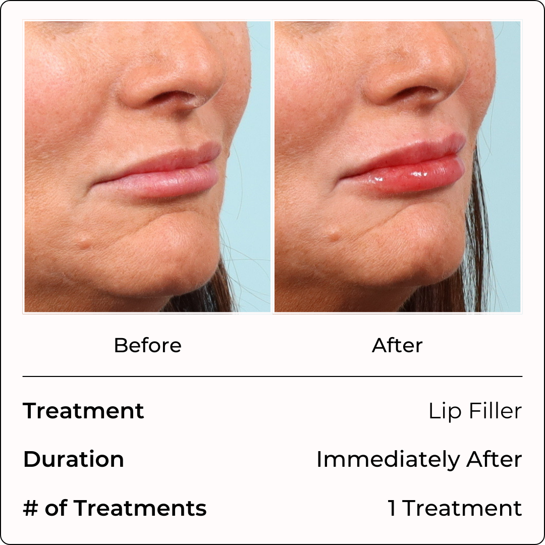 Filler Injections