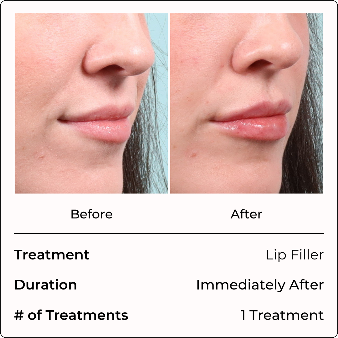 Filler Injections