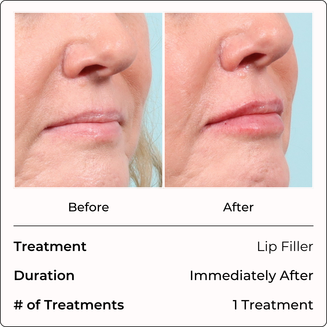 Filler Injections