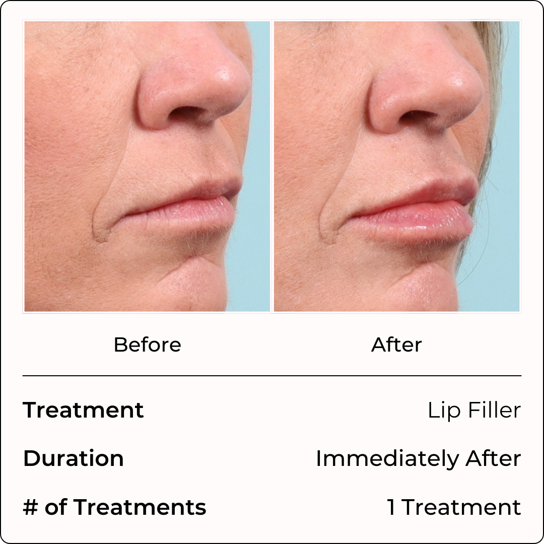 Filler Injections