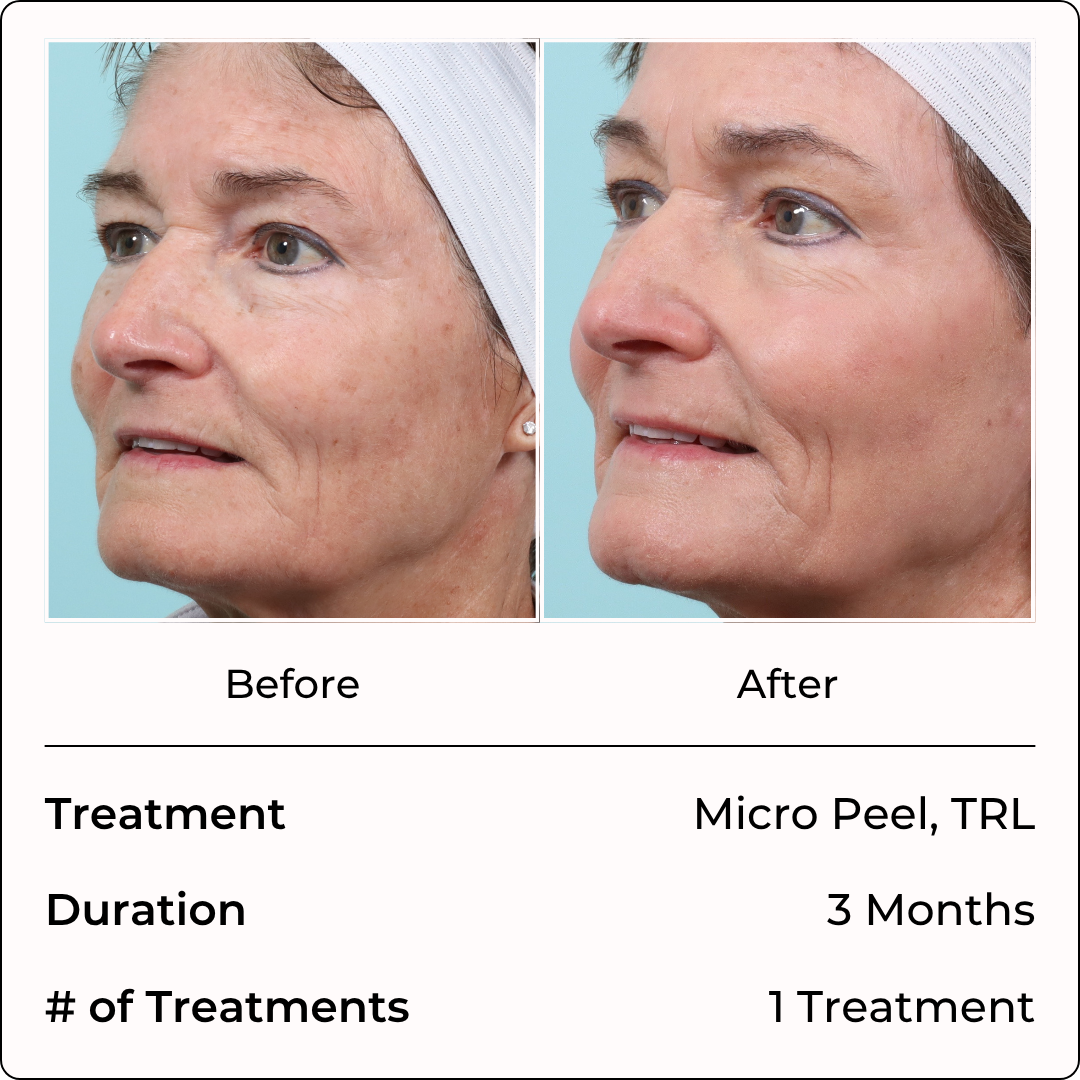 Micro Peel, TRL