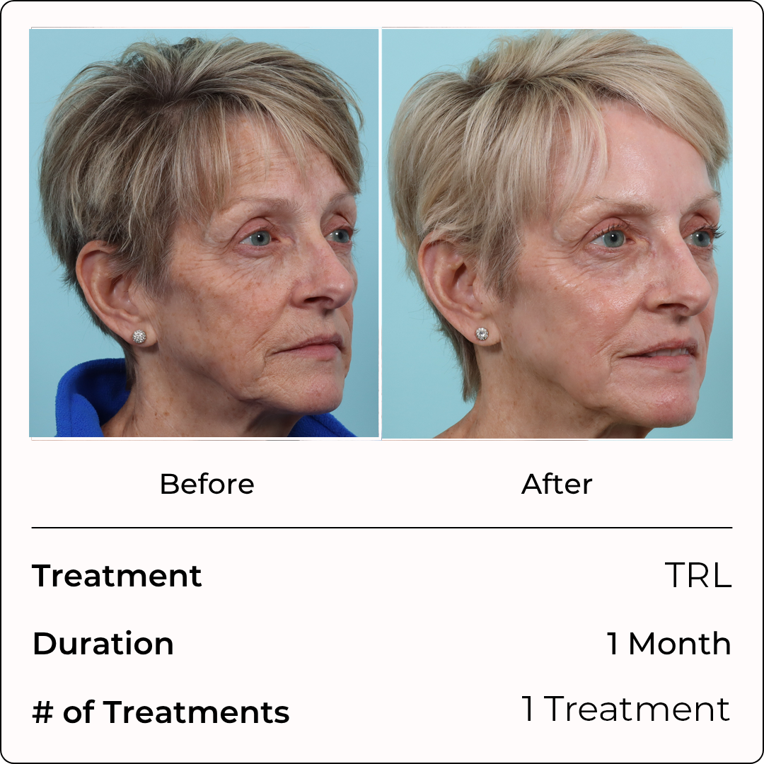 TRL (Copy)
