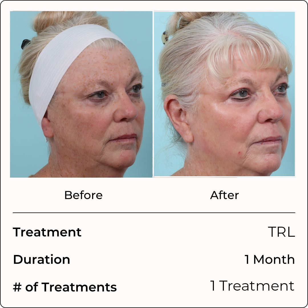 TRL (Copy) (Copy)