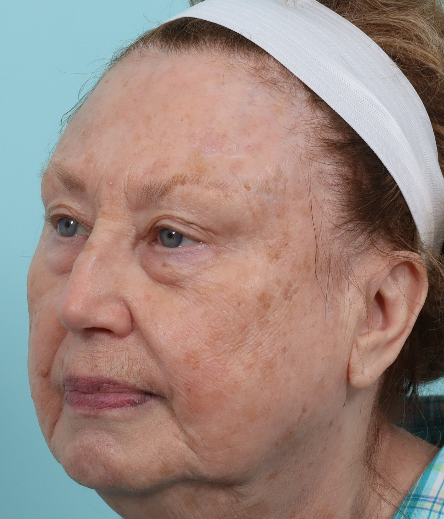 micro peel l b.png