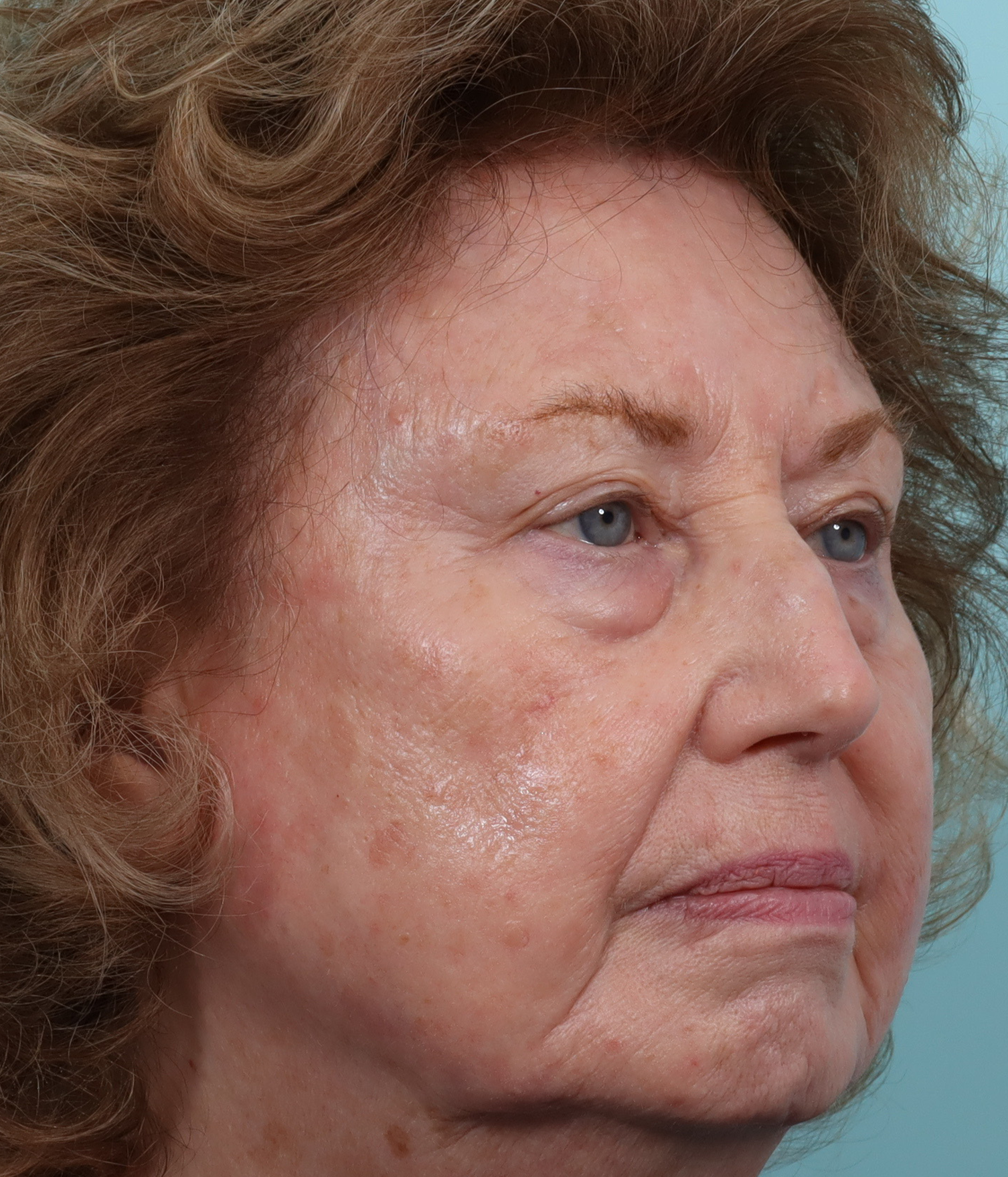 micro peel r a.png