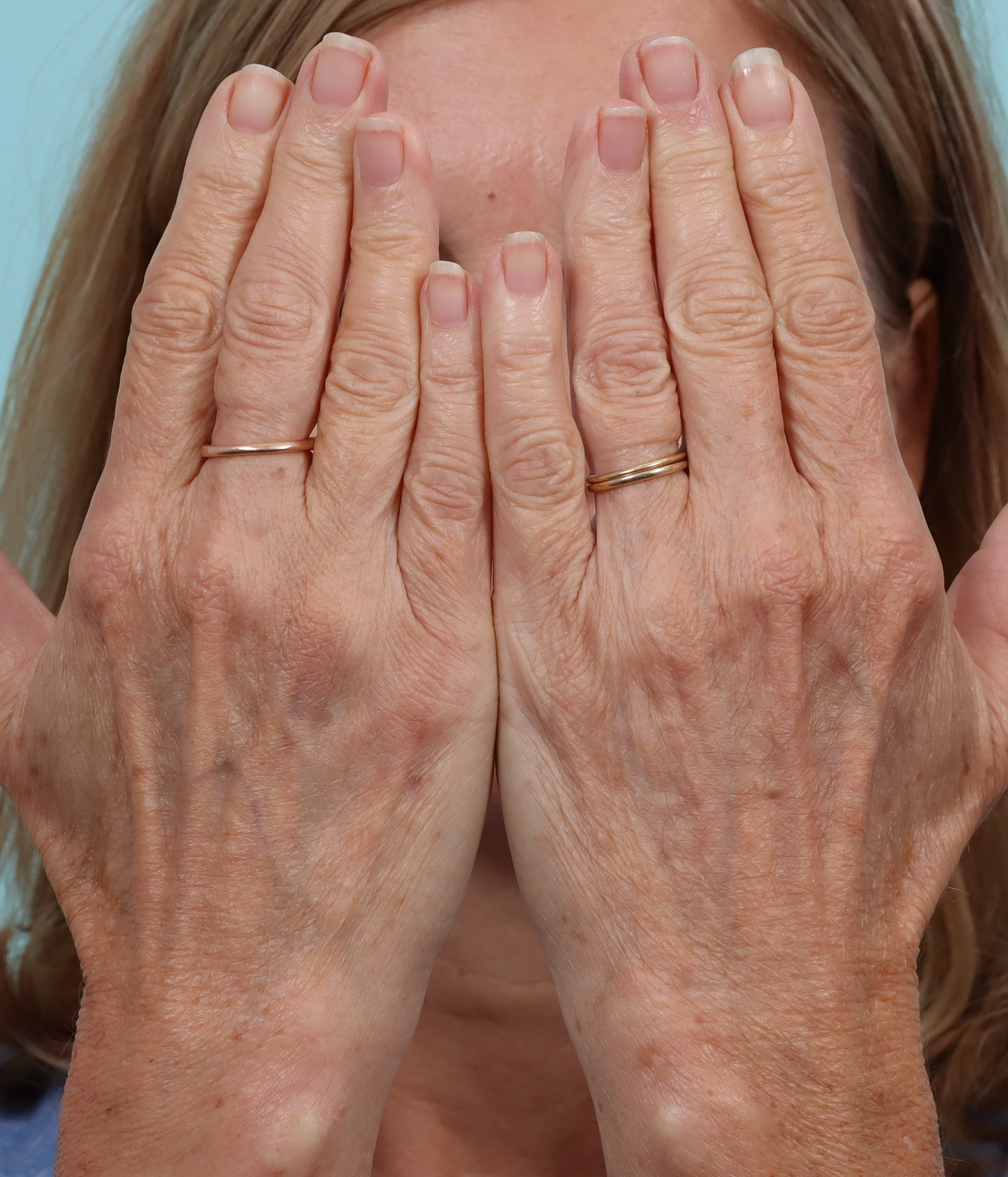 hands after bbl.png