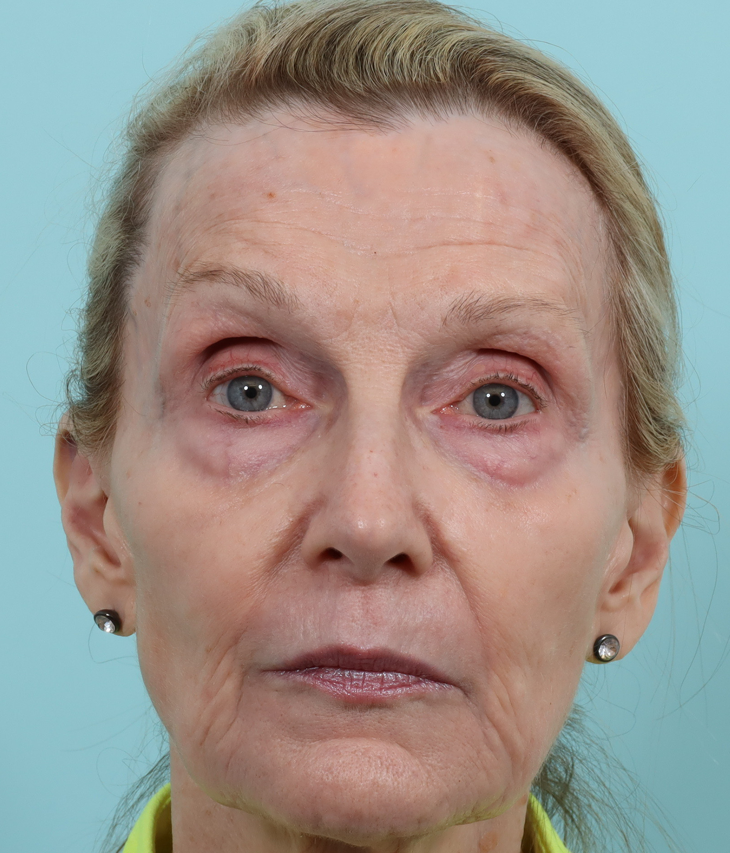 Laser resurfacing before and after showing smoother skin texture and more even tone