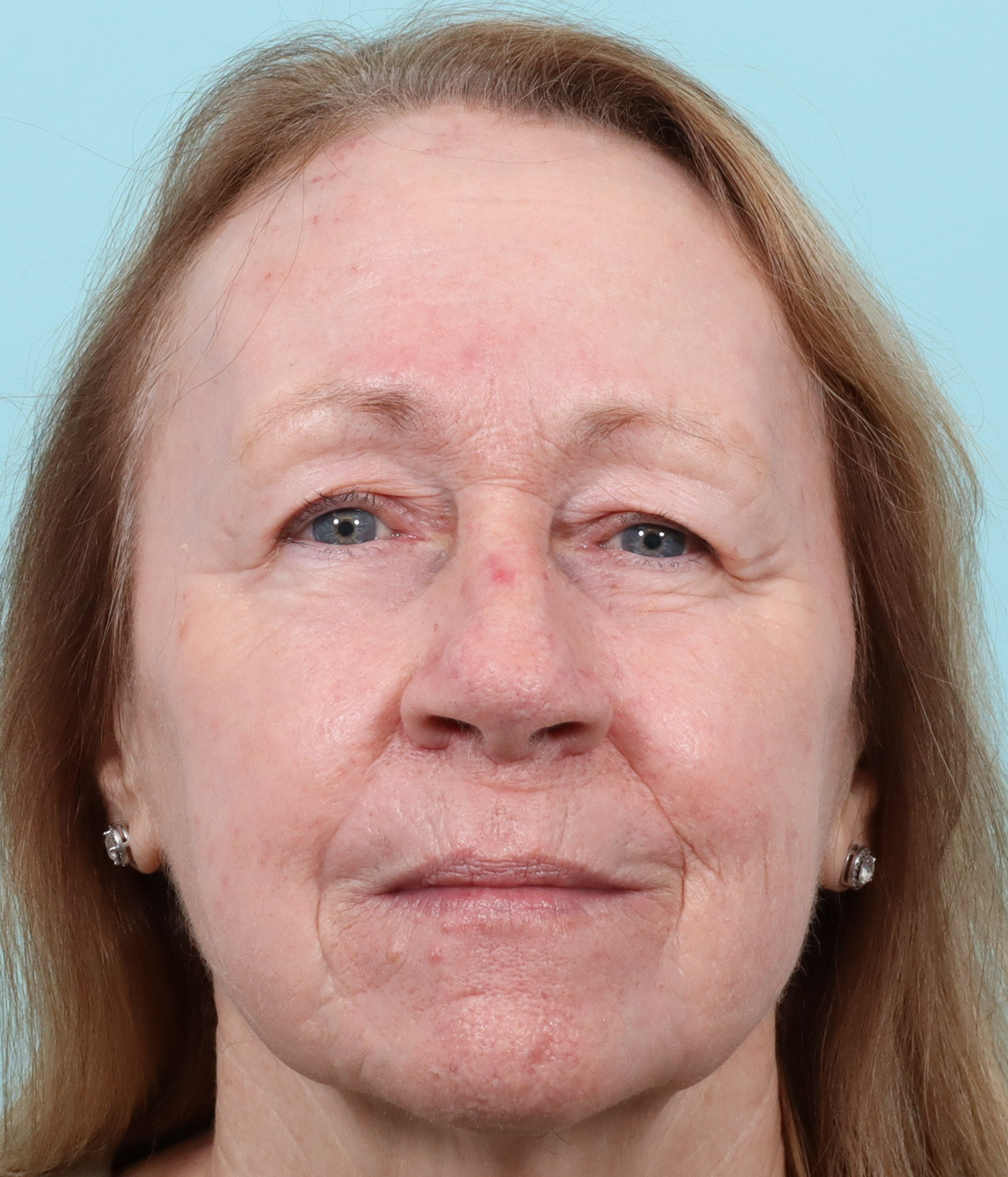 TRL 3 months after laser transformation front.png