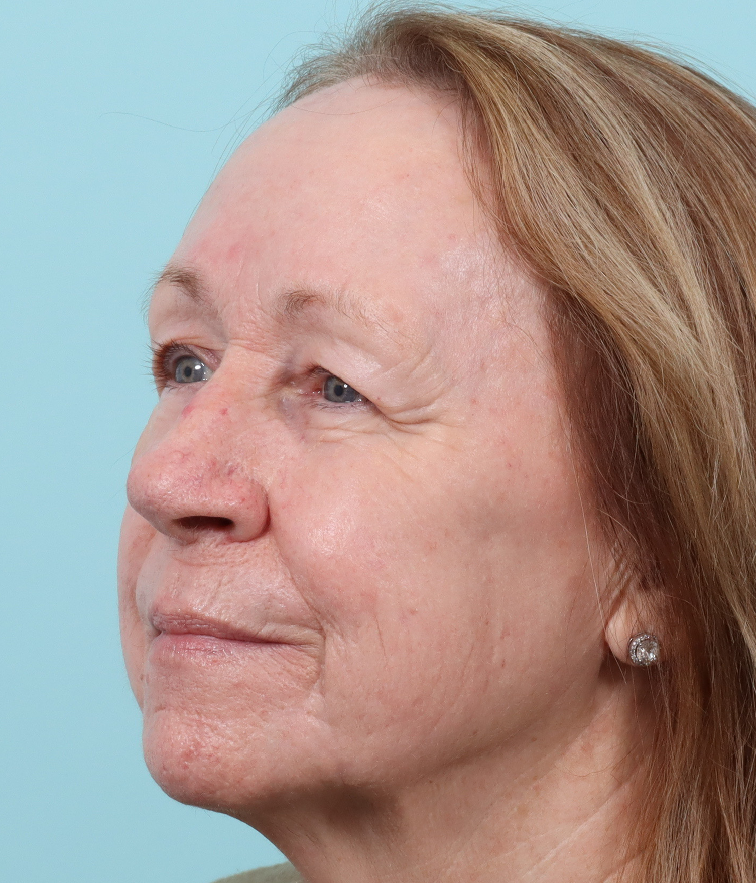 TRL 3 months after laser transformation left.png