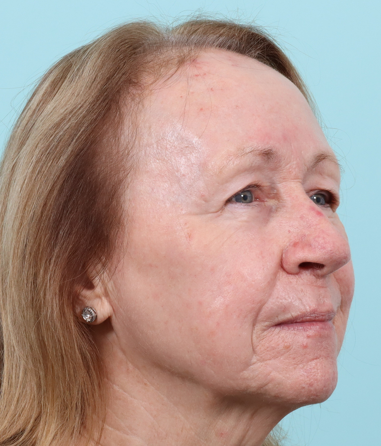 TRL 3 months after laser transformation right.png
