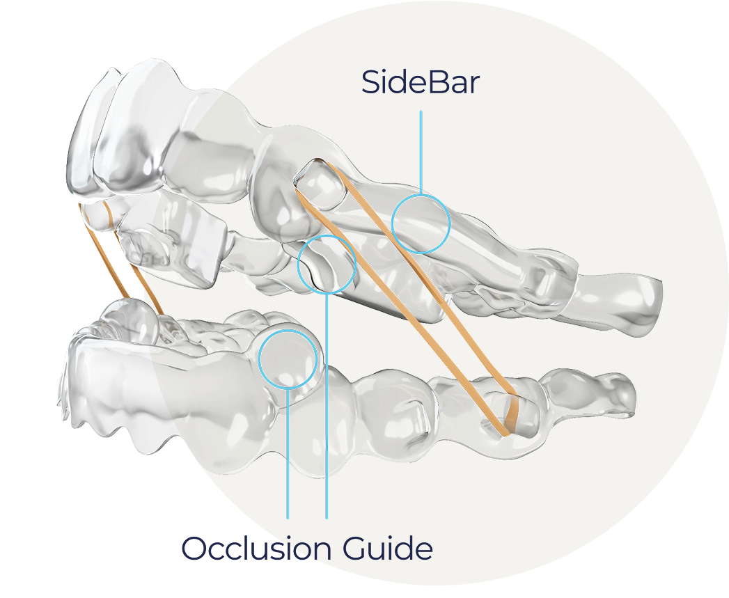เครื่องมือจัดฟันใส Spark พร้อม BiteSync สำหรับปรับการสบฟัน
