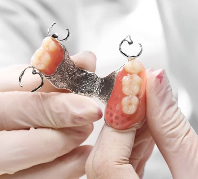 ฟันปลอมฐานโลหะแบบบาง แข็งแรง สวมใส่สบาย เชียงใหม่ Metal base denture with slim design and strength in Chiangmai