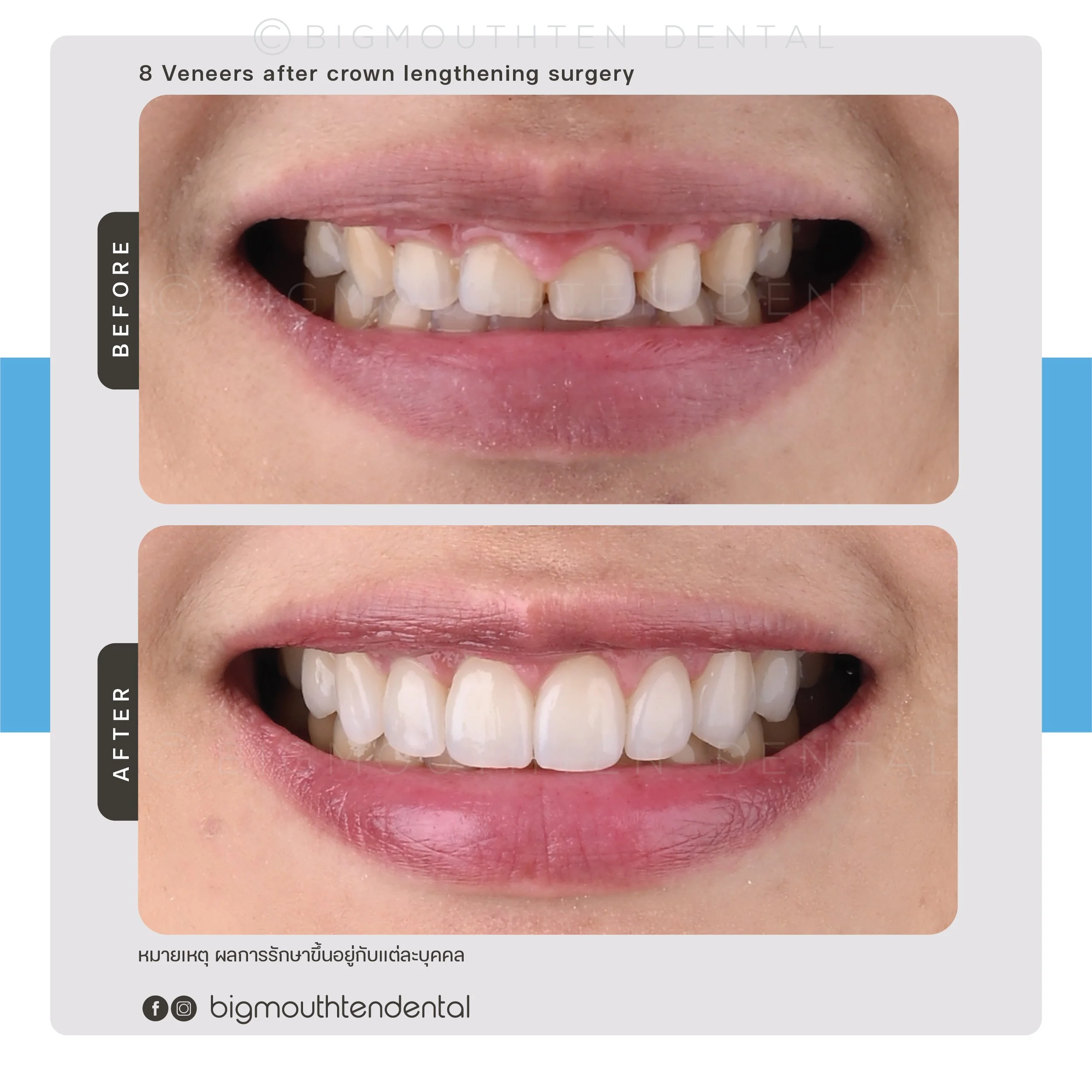 veneers-before-after-chiangmai-bigmouthten.jpg.jpg