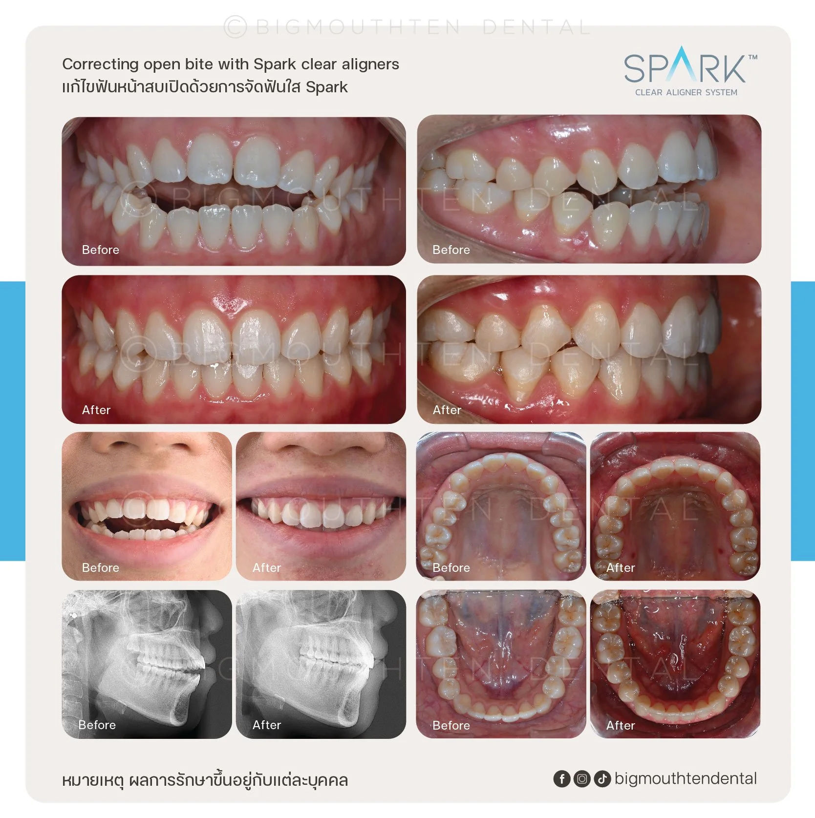 Before and after images showing dental alignment correction with Spark clear aligners, including photos of teeth, X-rays, and dental arches.