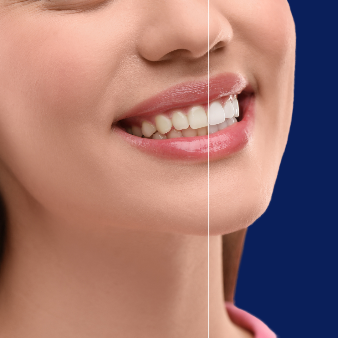 Close-up of a woman's smile showing teeth, illustrating a before and after comparison of teeth whitening.