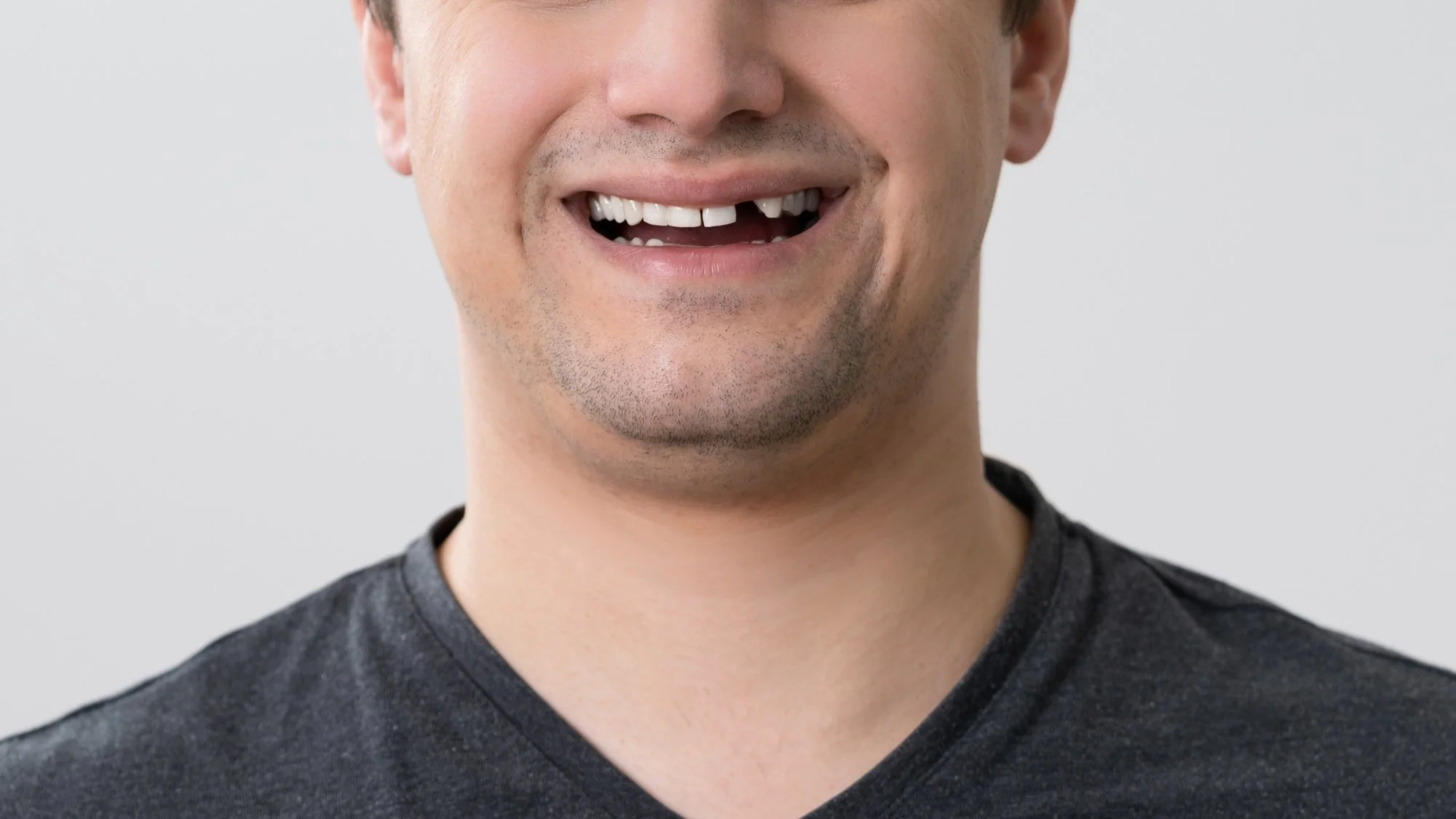 Dental Implant vs. Dental Bridge: Which is Right for You?