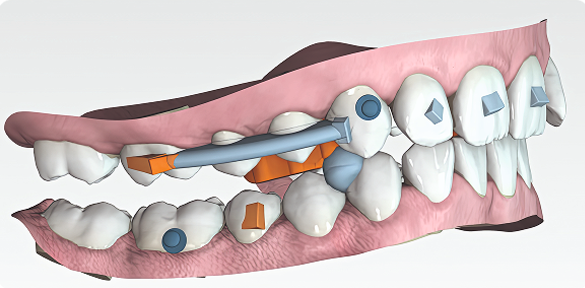 Digital illustration of a dental implant procedure showing a metal implant screw, abutment, and crown in the upper jaw.