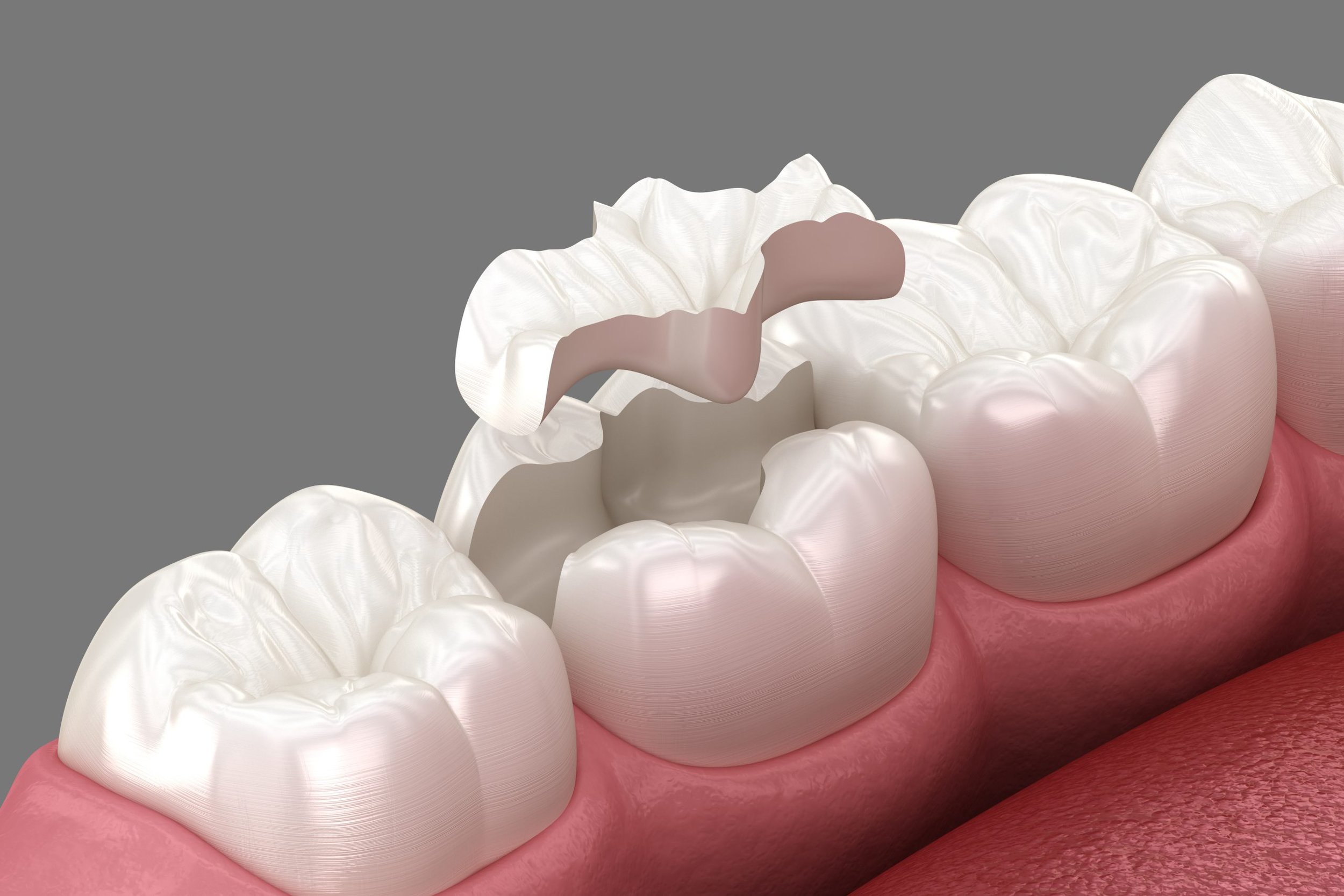 3D illustration of a dental inlay being placed on a molar tooth in an open mouth.