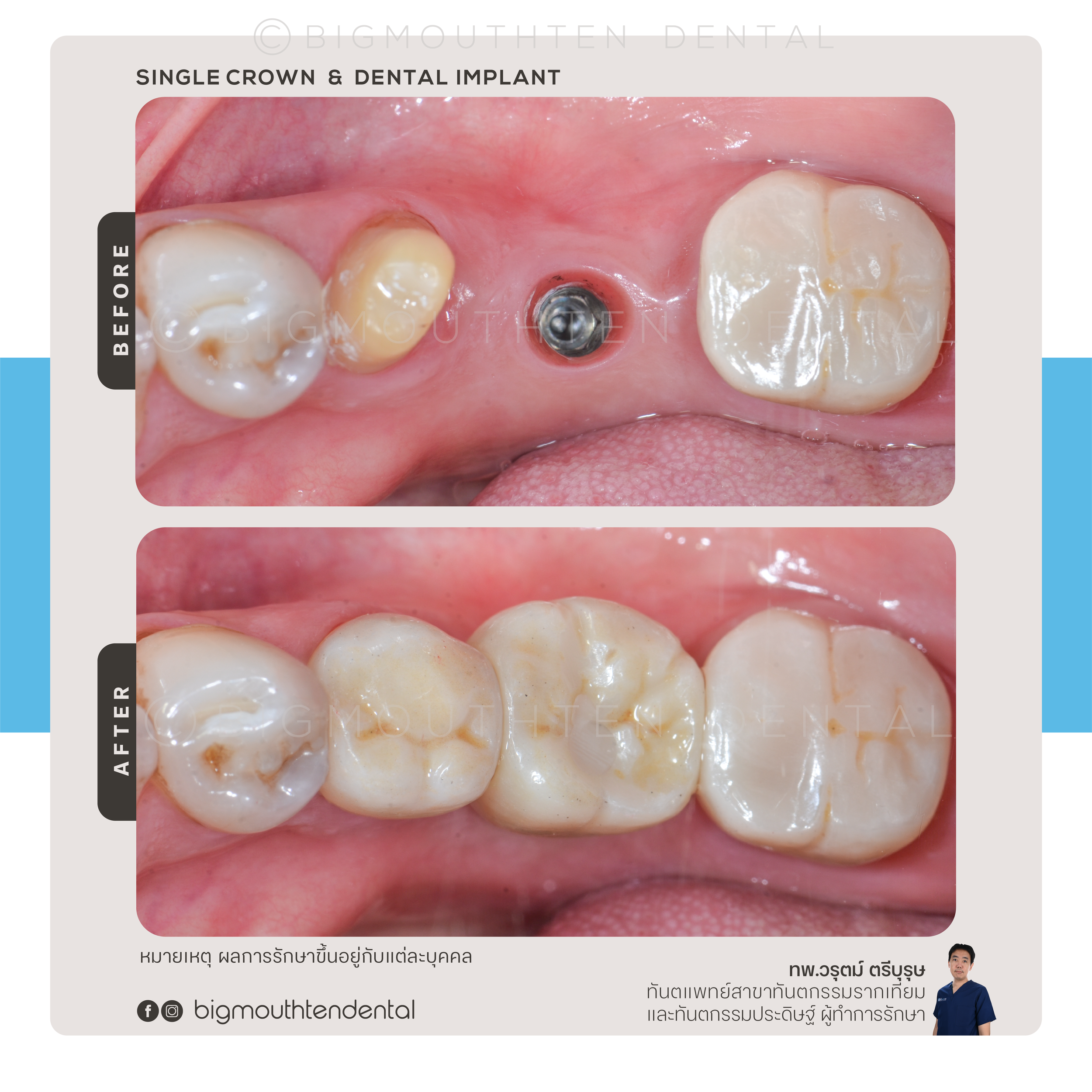 ผลลัพธ์การบูรณะฟันด้วยรากเทียมเพื่อทดแทนฟันที่หายไป
Dental restoration with implant to replace missing teeth