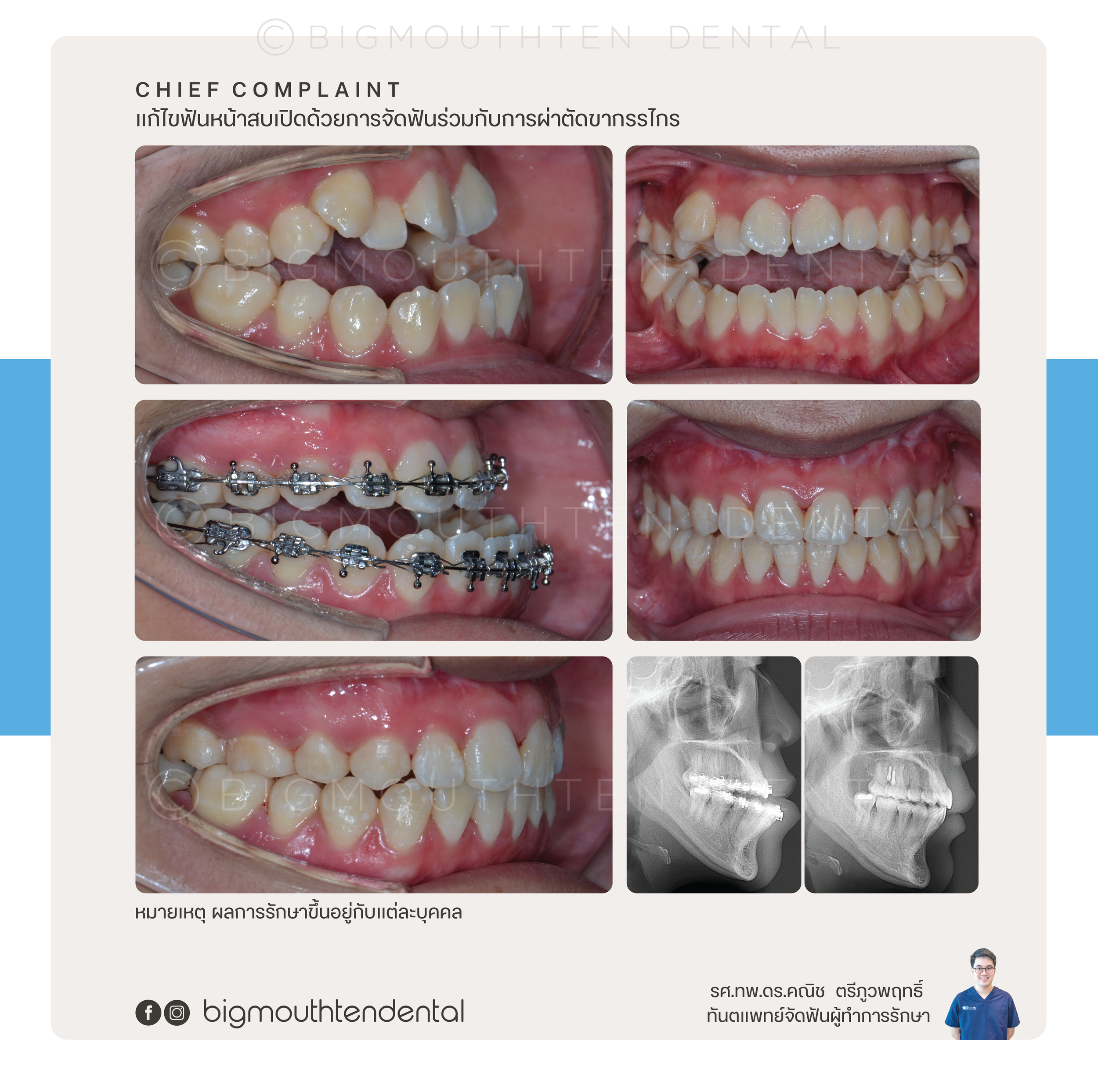 Before&After-jaw-surgery-orthodontic-braces-bigmouthten-chiangmai.png