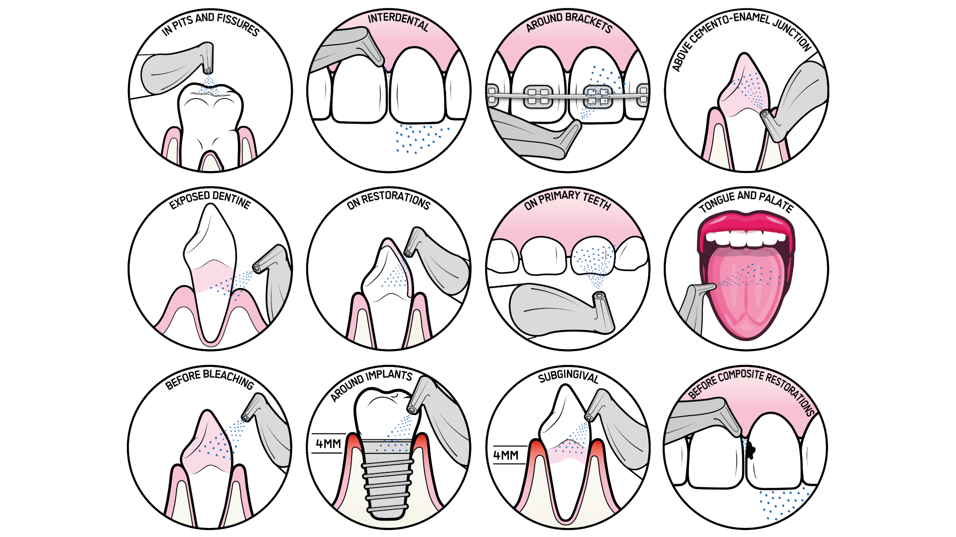 ฟันมีคราบชา กาแฟ คราบจุลินทรีย์ ฟันติดเครื่องมือจัดฟัน ฟันปลอม เหงือกอักเสบ ก่อนทำ GBT Airflow ที่ Bigmouthten Chiangmai | Teeth stain, plaque, braces, prosthetics, inflamed gums before GBT Airflow treatment at Bigmouthten Chiangmai